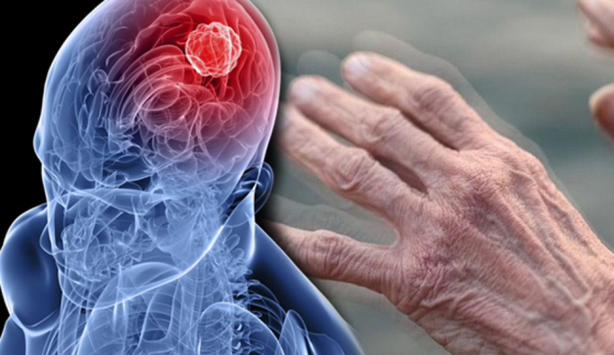 يُمكن أن يكشف عن خطر الإصابة بمرض Parkinson قبل ظهور أي أعراض سريرية