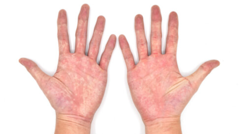 سبب ازرقاق اليدين في الشتاء