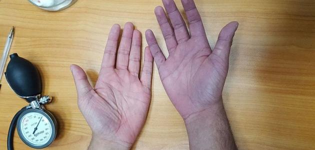 هل فقر الدم يسبب ازرقاق اليدين؟