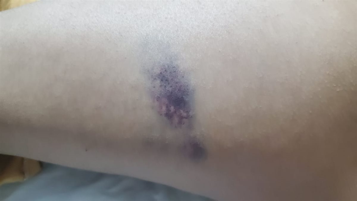 جسد التلميذ بعد التعدي عليه بالضرب في قنا