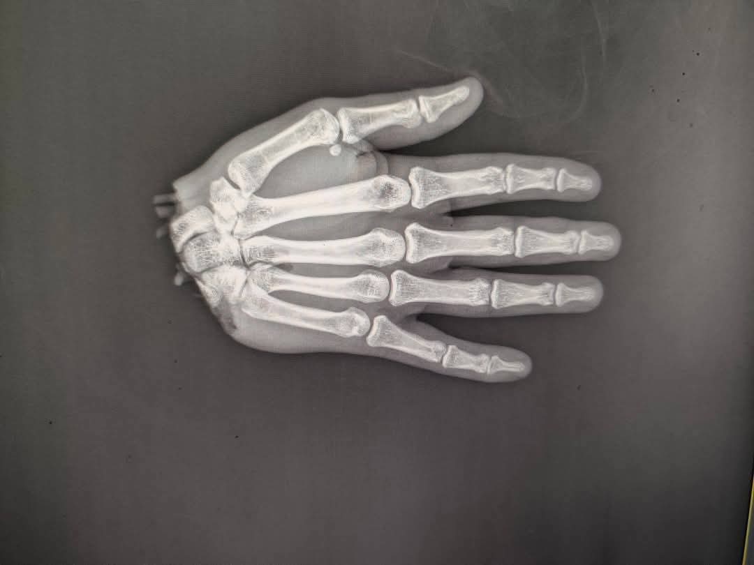 أشعة تظهر يد المريض بعد قطعها في حادث وقبل إجراء العملية