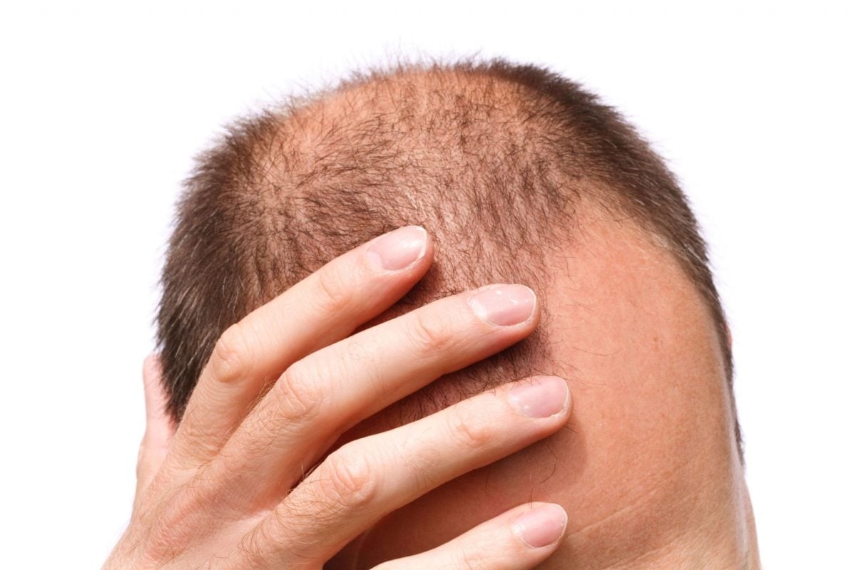 أسباب تساقط الشعر المفاجئ عند النساء والرجال&nbsp;
