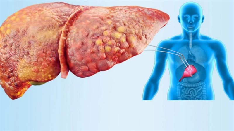 دراسة علمية تؤكد ارتفاع مخاطر عدوى التهاب الكبد هـ بعد زراعة الأعضاء