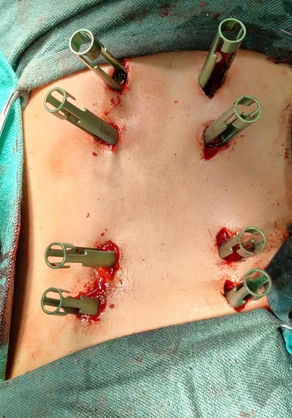 سقط من ارتفاع 7 أمتار.. طب أسيوط الأزهر تجري عملية لتثبيت العمود الفقري باستخدام تقنية التدخل المحدود<br>&nbsp;