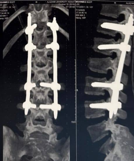 سقط من ارتفاع 7 أمتار.. طب أسيوط الأزهر تجري عملية لتثبيت العمود الفقري باستخدام تقنية التدخل المحدود<br>&nbsp;
