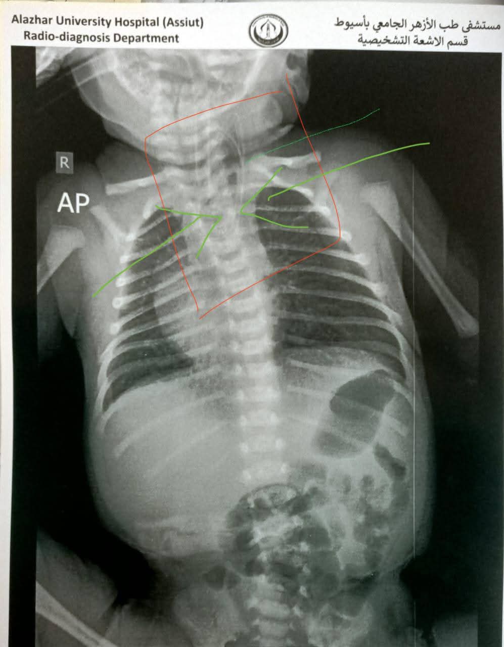مستشفى جامعة الأزهر بأسيوط ينقذ حياة رضيع&nbsp;