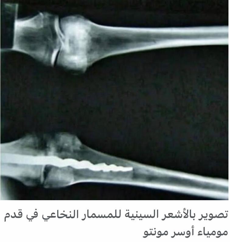 مسمار في قدم مومياء&nbsp;