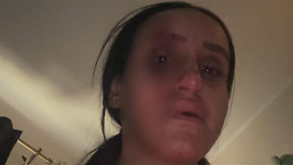 <strong>زوجة بشتيل ضحية اعتداء زوجها</strong>