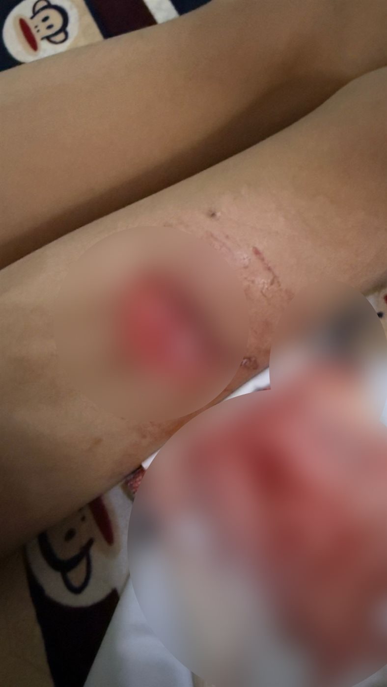 &nbsp;كلب يهاجم صغيرة 7 سنوات أثناء بروفة مسرحية ويصيبها بتشوهات خطيرة
