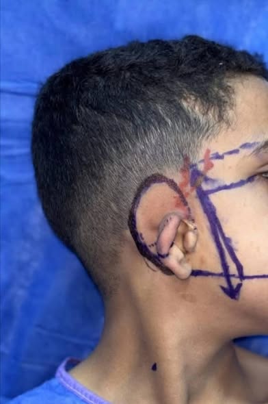 طب الأزهر بدمياط تعيد تشكيل أذن صغير 11 سنة وتمنحه بداية مختلفة