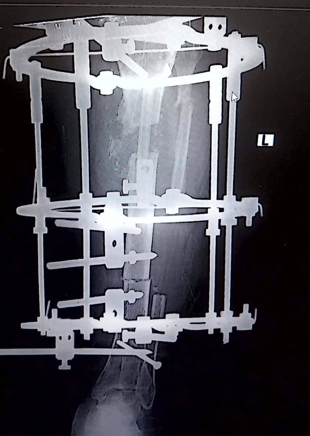 نجاح جراحة زراعة عظام لمسنة بالأقصر&nbsp;