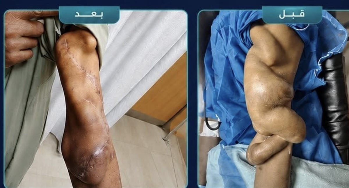إنقاذ قلب مريض غسيل كلوي بمستشفى الكرنك&nbsp;