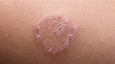 تشخيص أول امرأتين بنيويورك بعدوى فطرية شديدة العدوى مقاومة للأدوية