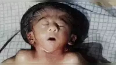 مشاكل خلقية نادرة.. الهند تشهد ولادة طفلة بـ 4 أذرع و4 أرجل وقلبين