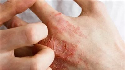بعد وفاة 5 أشخاص في الهند.. تعرف على أعراض ومضاعفات عدوى التيفوس الفركي 