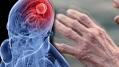25 مليون حالة بحلول 2050.. علماء يحذرون من ارتفاع الإصابة بأمراض الدماغ المنهكة
