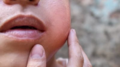 أبرزها تورم الوجه.. تعرف على أعراض مرض النكاف وكيفية علاجه