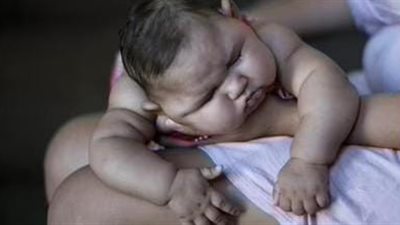 أبرزها مشاكل الأنبوب العصبي.. أنواع العيوب الخلقية وعلاجها