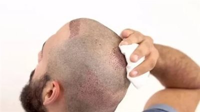 هل زراعة الشعر في سن مبكرة قرار صائب؟.. خبير يوضح الحقيقة