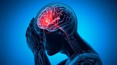 دراسة تكشف تأثير الالتهابات وسوء التغذية على تفاقم مضاعفات السكتة الدماغية