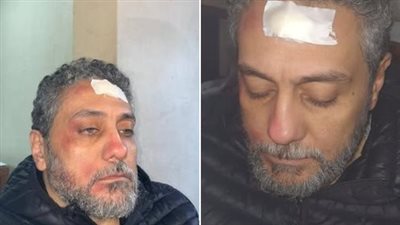 زوجة تامر فرج تكشف تعرضه لحادث خلال التصوير: وحدة إضاءة وقعت على راسه.. الحمد لله جت سليمة