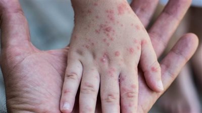 أسباب تفشي مرض الحصبة في بنجلاديش