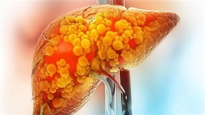 دراسة تحذر من أن أمراض الكبد الأيضية: قد تصيب ملياري شخص بحلول عام 2050