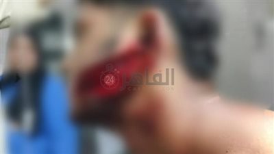 جرح عميق في الوجه.. ننشر التقرير الطبي لشاب من ذوي الهمم بالمنوفية بعد الاعتداء عليه بسبب خلاف على الأجرة