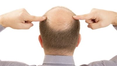 دراسة: علاج جديد للصلع لدى الرجال يُظهر نتائج واعدة خلال عام