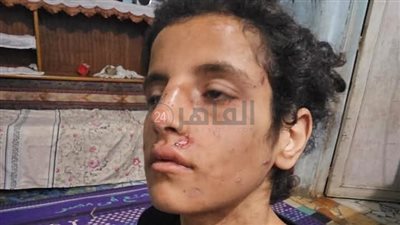 محامي صغيرة بالمنوفية يتهم والدها وزوجته بالتعدي عليها بالضرب وإحداث إصابات