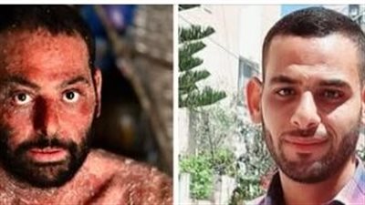 4 سنوات من المعاناة.. شاب من غزة مصاب بمرض نادر يستغيث لتلقي العلاج بالخارج