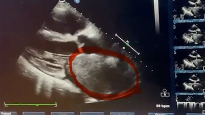 فريق جراحة القلب بقصر العيني ينجح في استئصال ورم نادر بحجم قبضة اليد من قلب مريض سبعيني