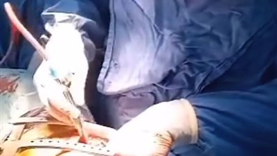 جراحة دقيقة تنقذ صغيرًا من مسمار في القلب بمستشفيات قصر العيني 