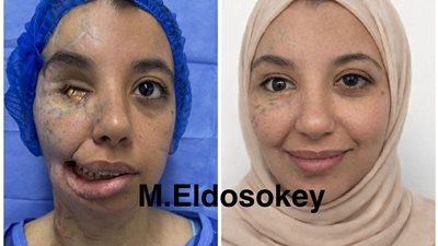 عانت من إصابات بالغة نتيجة الحرب.. فريق طبي مصري ينجح في إجراء جراحات دقيقة لفتاة من غزة 