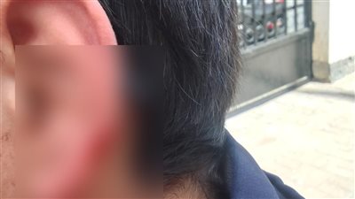 عضه من ودنه.. ولية أمر طالب بمدرسة إعدادية بالإسكندرية تستغيث بعد قطع جزء من أذن ابنها