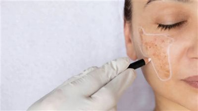 طرق علاج الكلف الصيفي بالليزر