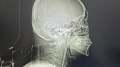 شخص يقضي 8 سنوات بعود معدني في حلقه.. واقعة طبية نادرة في الصين