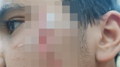 إصابة طالب بجرح قطعي في الوجه على يد شاب حاول سرقة هاتفه بالإكراه بروض الفرج