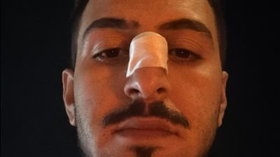 كانوا بيلعبوا بالعربيات في زفة فرح.. شاب يستغيث من الاعتداء عليه إثر حادث على وصلة دهشور: 15 واحد ضربوني |خاص 