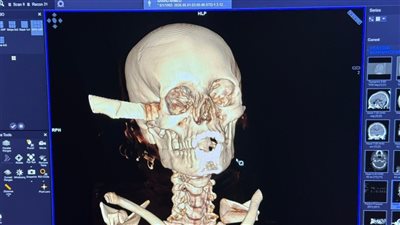 استخراج سكين من قاع الجمجمة.. فريق طبي متعدد التخصصات ينقذ مريضة شابة بقصر العيني