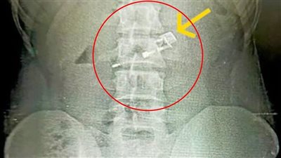استخراج ولاعة من معدة مريض بمنظار عاجل في مستشفى المنصورة الدولي