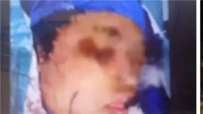 طعنة نافذة بالوجه و28 متفرقة.. ننشر التقرير الطبي لضحية الاعتداء من خطيبها بالمعصرة