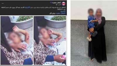 ضبط سيدة لاتهامها باستغلال ابنتها المصابة بحروق في أعمال التسول بالشرقية 