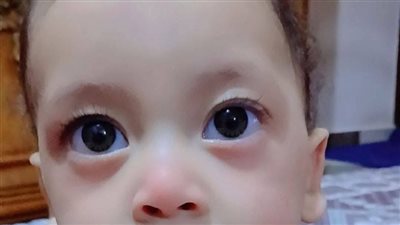 «ابتلع حبة فول سوداني وفارق الحياة».. القصة الكاملة لوفاة طفل داخل مستشفى المنزلة بالدقهلية