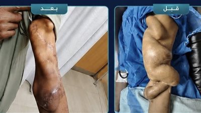  لحماية قلب مريض غسيل كلوي.. إصلاح تمدد وعائي ضخم بمستشفى الكرنك الدولي بالأقصر