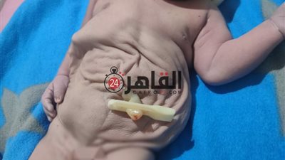 من أغرب الحالات.. ولادة طفل بمتلازمة البطن البرقوقي في الأقصر