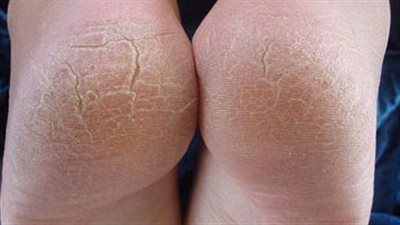 منها تجنب الماء الساخن والمواد الكيماوية.. تعرف على طرق علاج تشققات كعب القدم