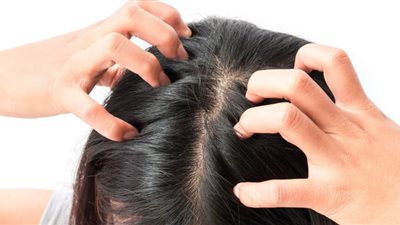 5 طرق لعلاج قشرة الشعر في فصل الشتاء