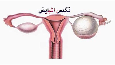 تعرفي على أشهر أعراض تكيس المبايض والوقاية منه