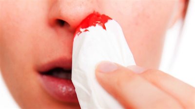 مع ارتفاع درجات الحرارة تزيد فرصة نزيف الأنف.. تعرف على الأسباب والعلاج